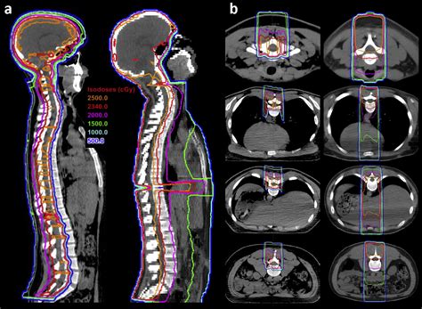 Proton Beam Craniospinal Irradiation Reduces Acute.